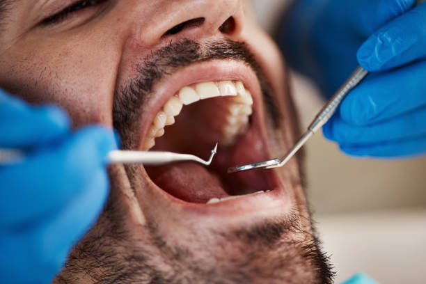 Best Emergency Tooth Extraction in Pulaski, VA
